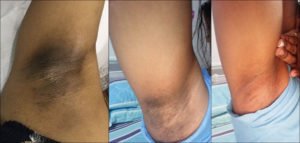 ミラノリピールで脇を3回治療した術後経過