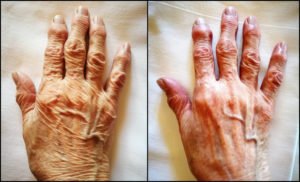 ミラノリピールで手を３回治療した術後経過