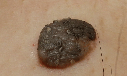 脂漏性角化症、イボ