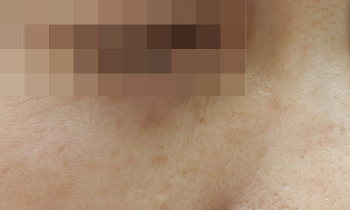 ホクロ除去の症例写真