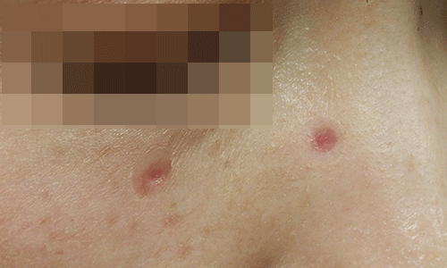 ほくろ除去の症例写真