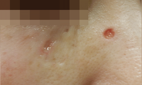 ほくろ除去の症例写真