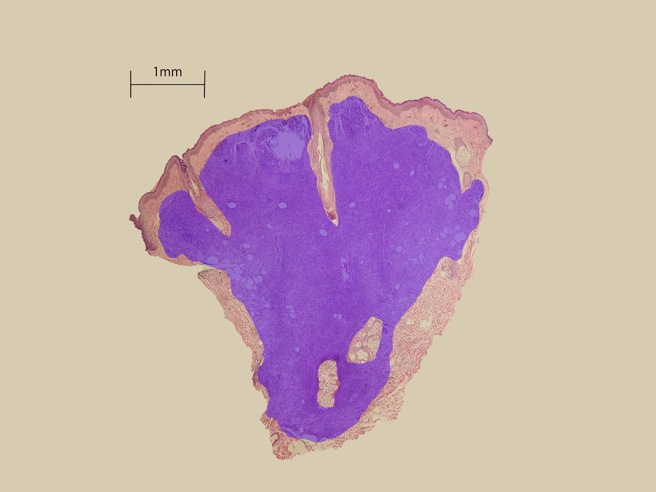 ほくろの病理写真マーカーあり