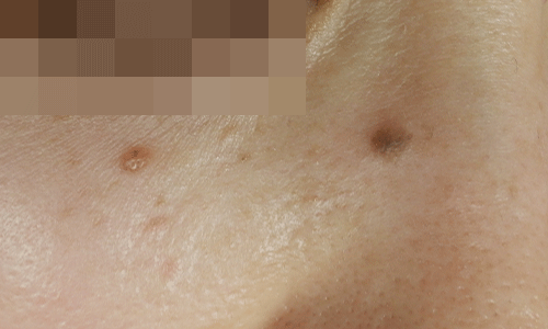 ほくろ除去前の写真