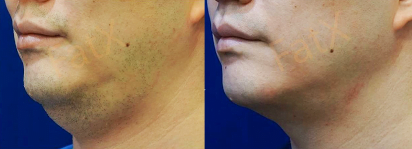 fat x coreの比較写真