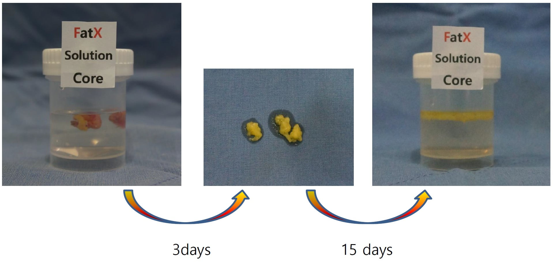 fat x coreの脂肪溶解注射の試験の写真