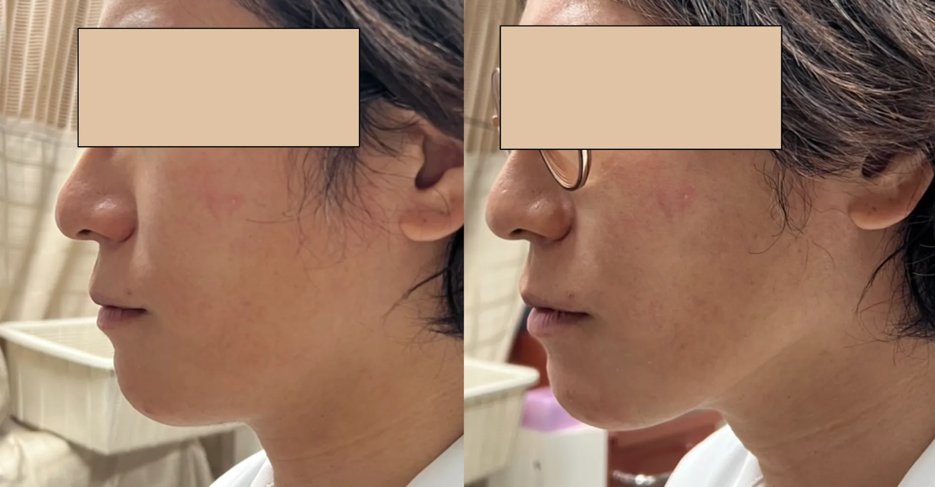 医療ハイフ（HIFU)｜埼玉県大宮｜いしだ皮フ科・美容皮膚科｜ウルトラ